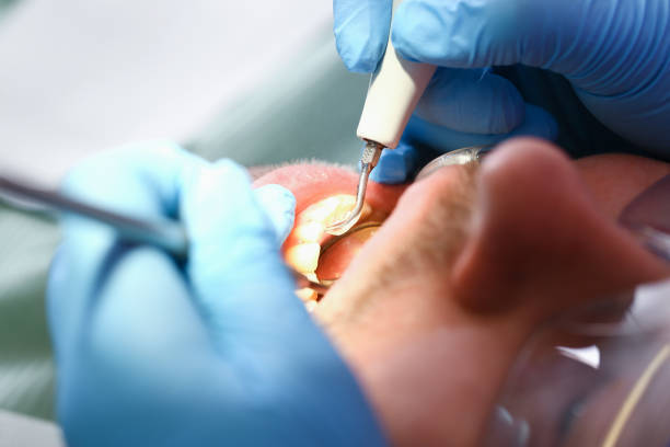 Best Emergency Dental Care for Broken or Chipped Teeth in Quincy, CA