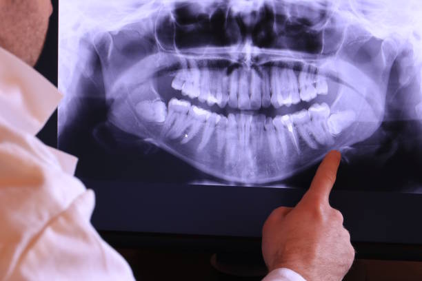Best Emergency Wisdom Teeth Removal in Quincy, CA