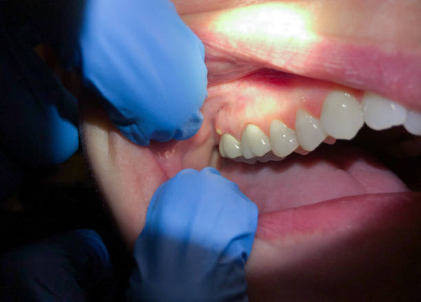 Best Emergency Dental Care for Broken or Chipped Teeth in Quincy, CA