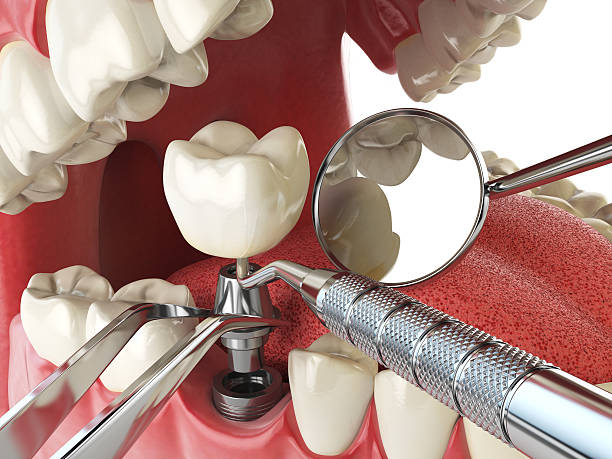 Best Urgent Care for Lost Fillings or Crowns in Quincy, CA